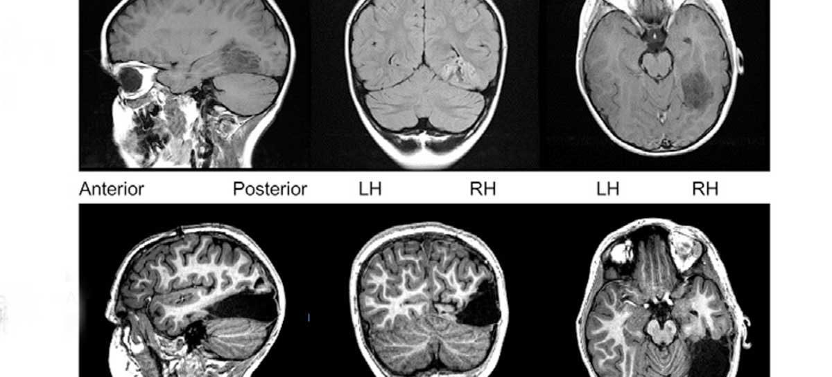 Boy’s Brain Works Just Fine After a Large Piece Was Removed